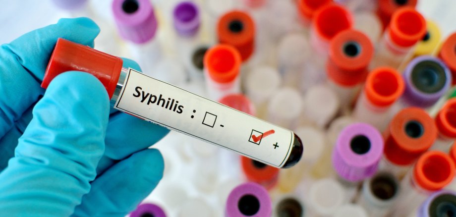 Blood sample with syphilis (Treponema Pallidum) positive
